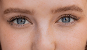 Résultat d’une blépharoplastie médicale au laser – Dr Prieur à Cagnes-sur-Mer