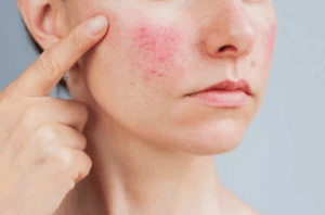 Couperose et rougeurs du visage – traitement laser Dr Prieur à Cagnes-sur-Mer