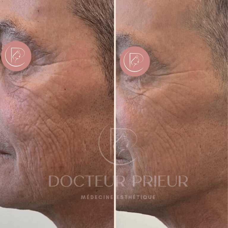 Résultat avant et après traitement laser des rides jugales – sujet 1 – joue gauche – Dr Prieur à Cagnes-sur-Mer