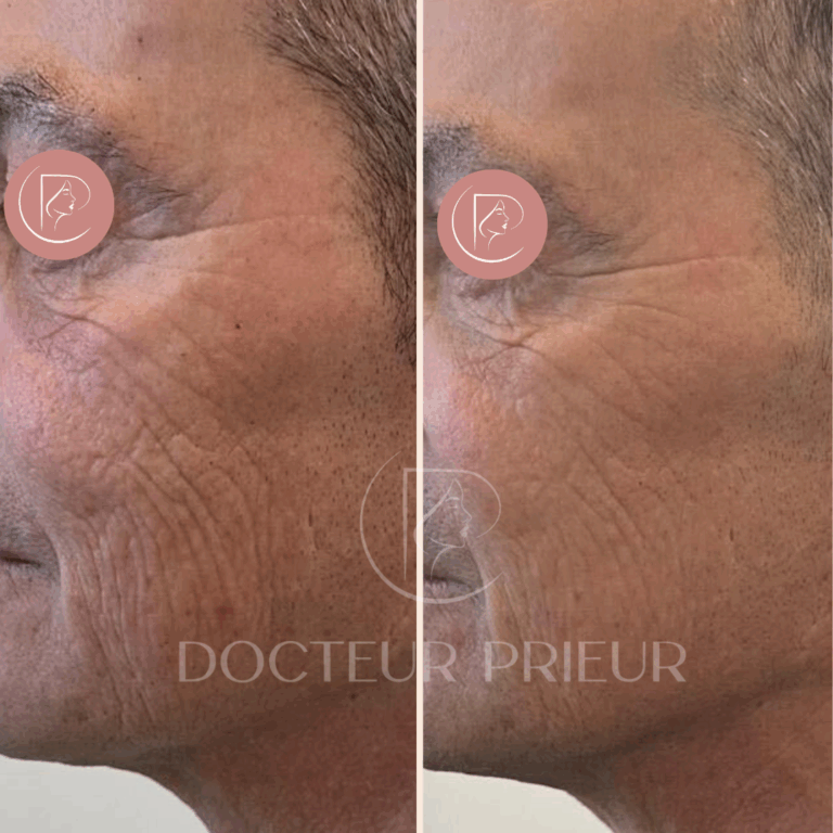 Résultat avant et après traitement laser des rides jugales – sujet 1 – joue gauche – Dr Prieur à Cagnes-sur-Mer