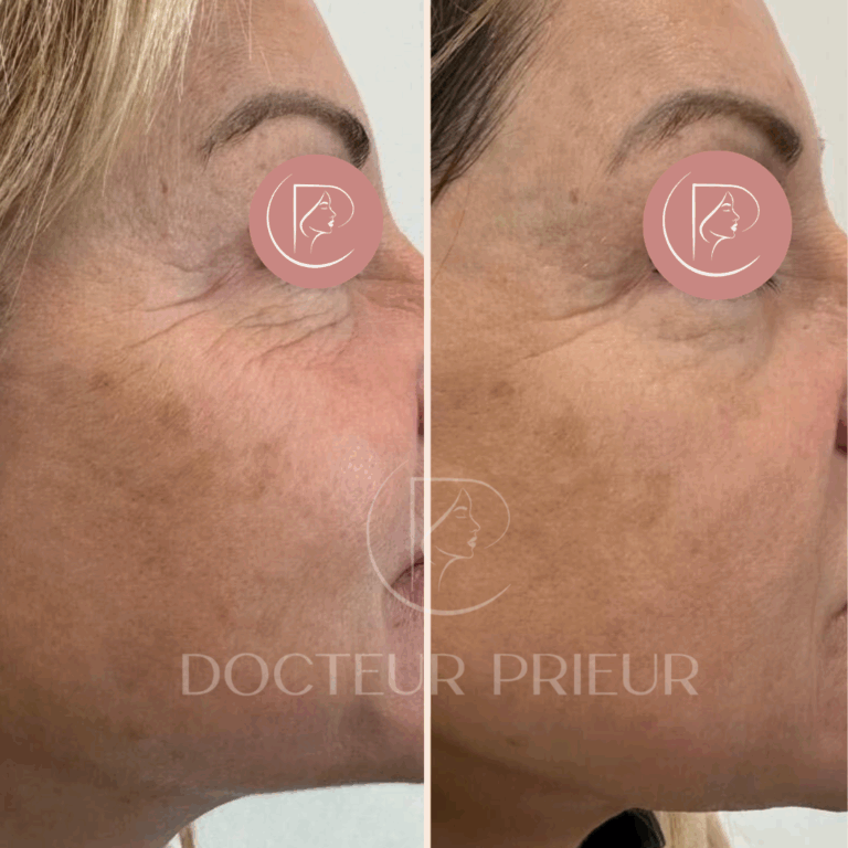 Résultat avant et après traitement laser des rides jugales – sujet 2 – joue droite – Dr Prieur à Cagnes-sur-Mer