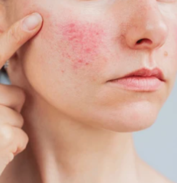 Rougeurs du visage-couperose Couperose et rougeurs du visage – traitement laser Dr Prieur à Cagnes-sur-Mer