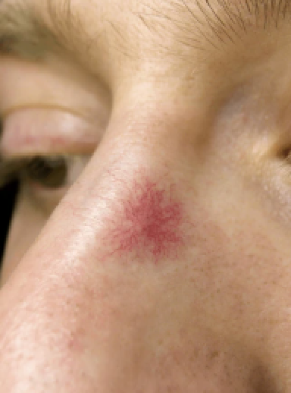 Rougeurs du visage-télangiectasies Tâche vasculaire et télangiectasies sur le nez – traitement laser Dr Prieur à Cagnes-sur-Mer